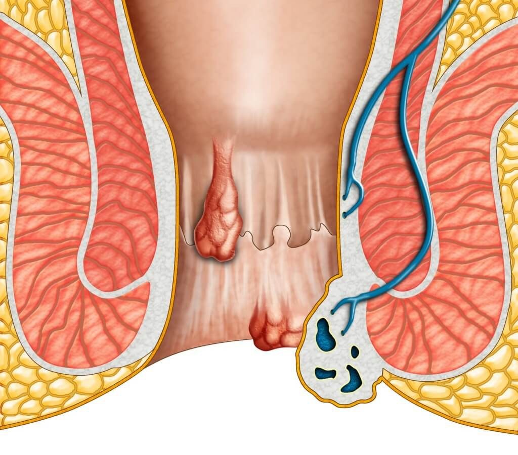 Bệnh trĩ bao lâu thì khỏi