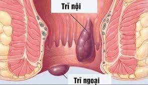 Hình ảnh minh họa bệnh trĩ nội