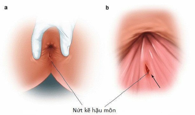 Bệnh trĩ nội có thể gây nứt kẽ hậu môn