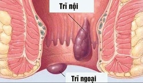 Trĩ ngoại và trĩ nội khác nhau ở vị trí xuất hiện búi trĩ