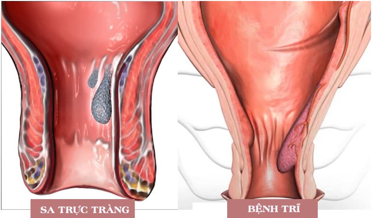 Sa nghẹt hậu môn là biến chứng của bệnh trĩ nội