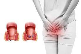 Bệnh trĩ ngoại điều trị cần nhiều thời gian và tiền bạc