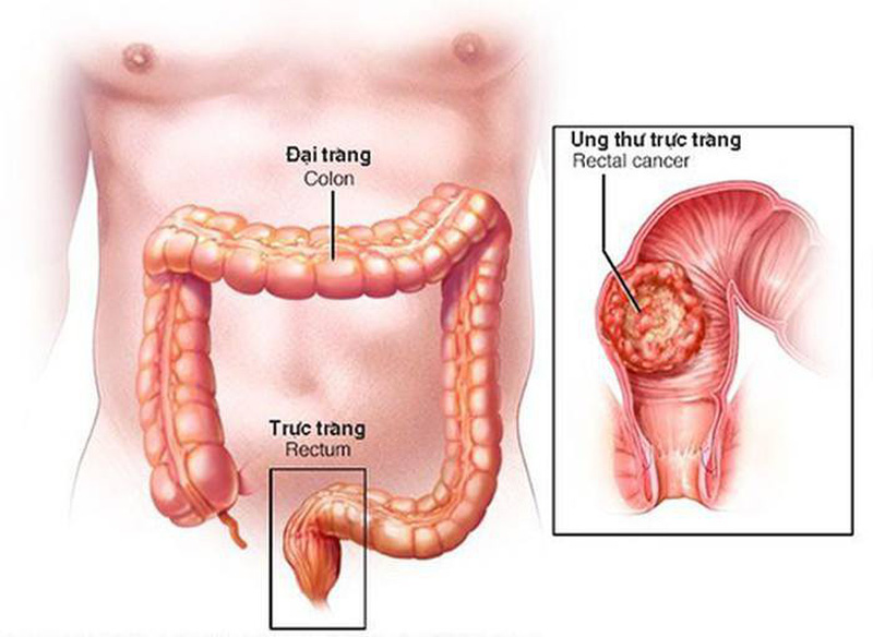 Ung thư trực tràng là biến chứng nguy hiểm nhất của bệnh trĩ