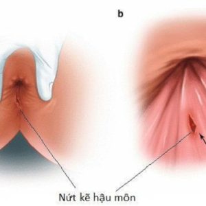 Dấu hiệu nứt kẽ hậu môn