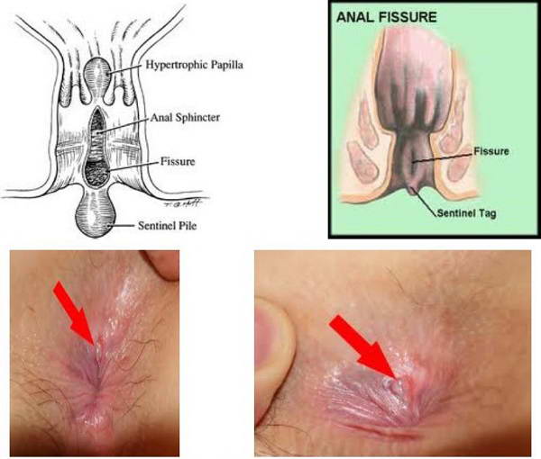Hình ảnh nứt kẽ hậu môn qua từng giai đoạn