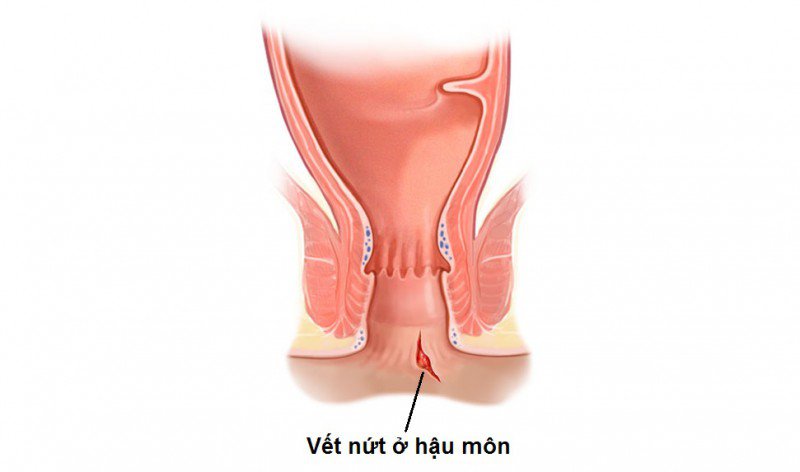 Vết nứt ở hậu môn