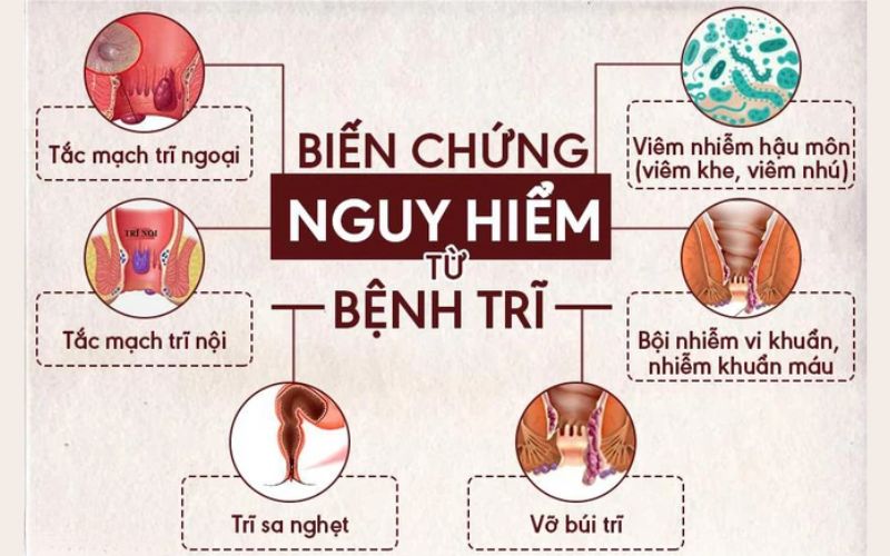 Trĩ hỗn hợp độ 2 và những điều bạn nhất định phải biết!