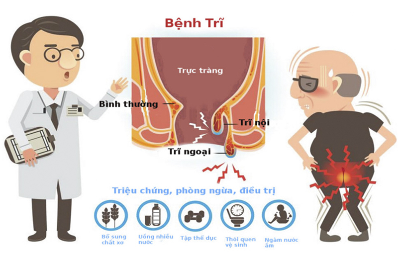 Trĩ hỗn hợp đi ngoài ra máu có nguy hiểm không?