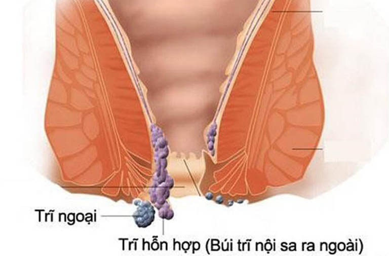 Bệnh trĩ hỗn hợp nguy hiểm không? Tất tần tật những điều cần biết về căn bệnh này!