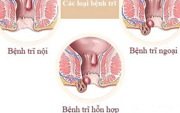 Trĩ hỗn hợp có chữa được không?