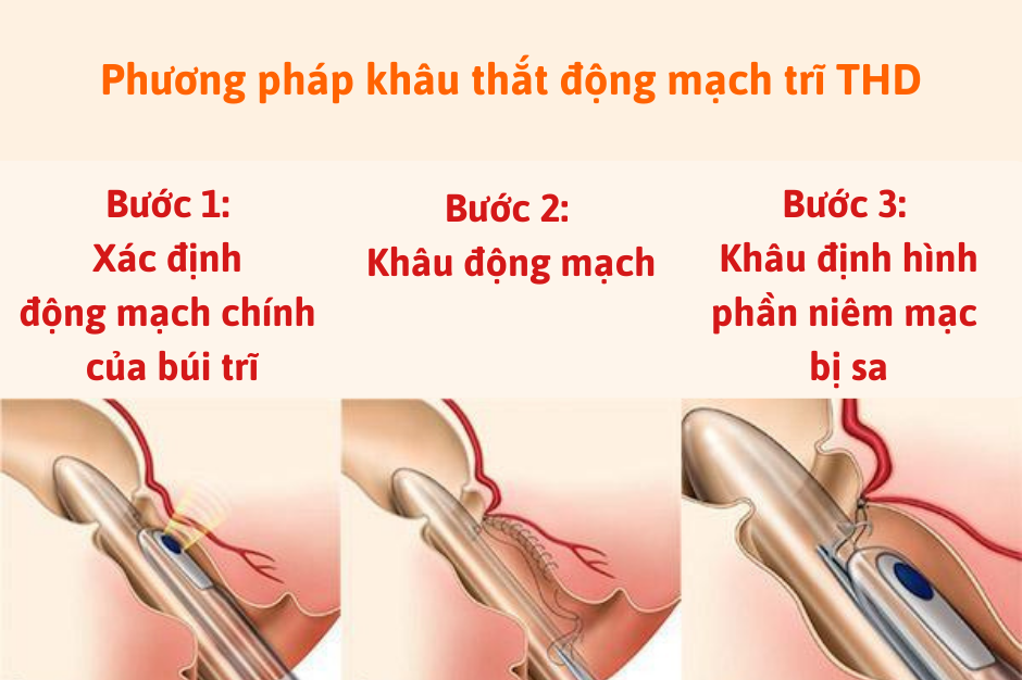 Trĩ hỗn hợp độ 4 chữa như thế nào?