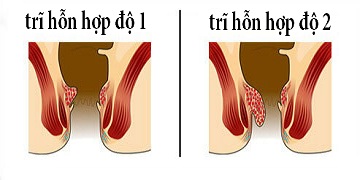 Trĩ hỗn hợp độ 2 và những điều bạn nhất định phải biết!