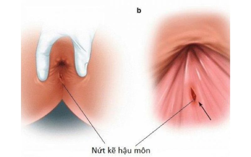 Giải quyết ngay nứt hậu môn mãn tính hiệu quả