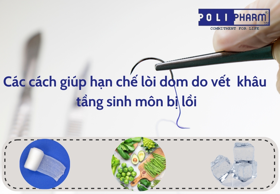 Cách hạn chế lòi dom vết khâu tầng sinh môn