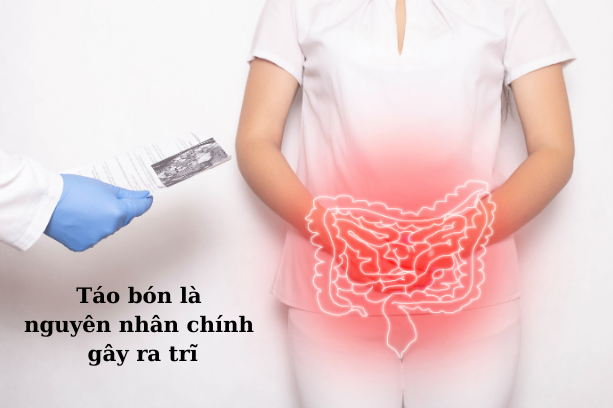 Táo bón & Trĩ: Mối liên hệ ít ai ngờ