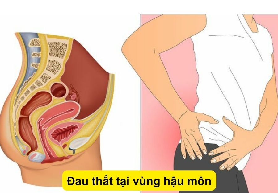 Top 4 dấu hiệu trĩ ở phụ nữ sớm nhất