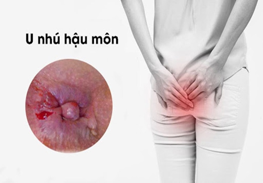 Nhú phì đại có nguy hiểm không?