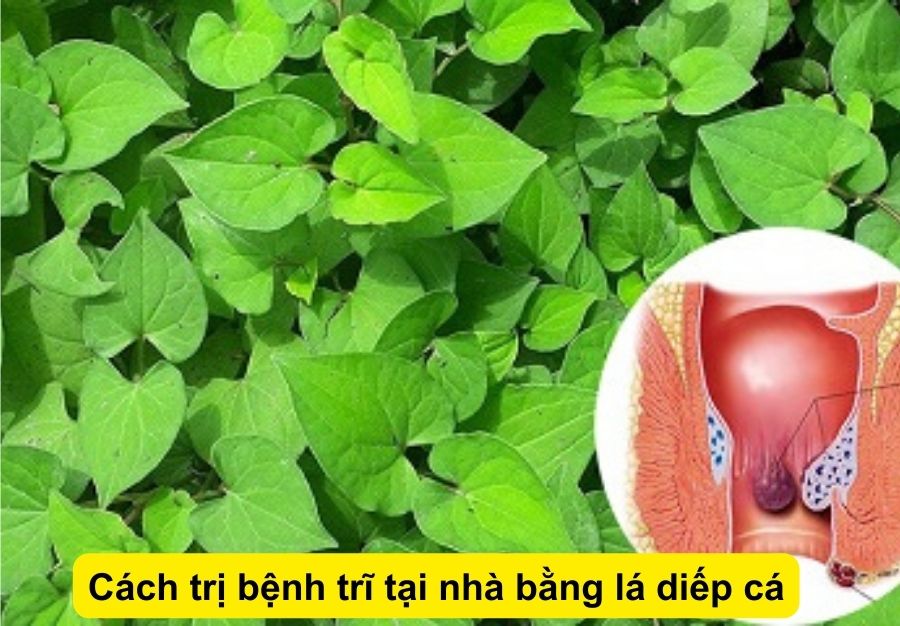 TOP 5 cách trị bệnh trĩ hiệu quả tại nhà